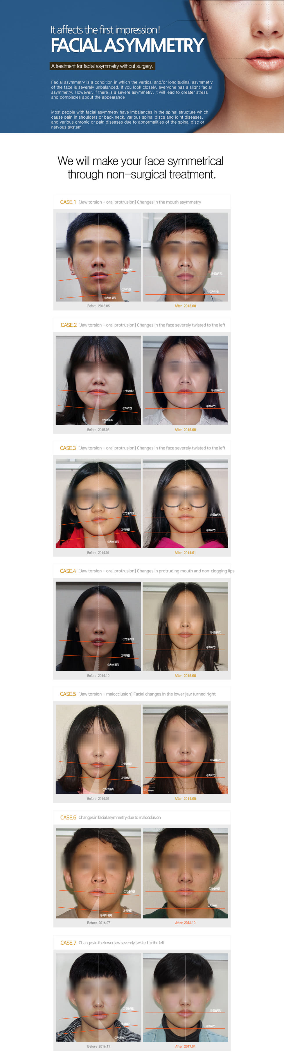 facial asymmetrycial asymmetry